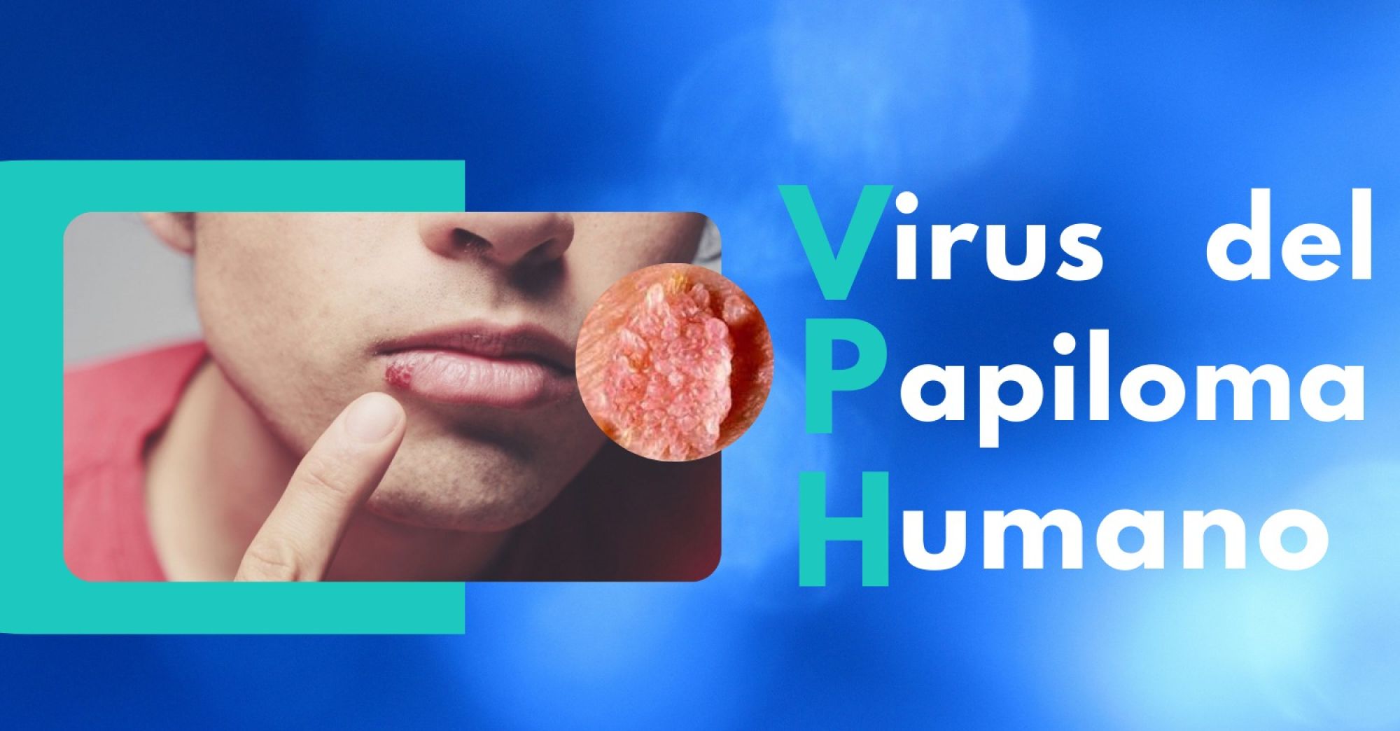 Virus del Papiloma Humano